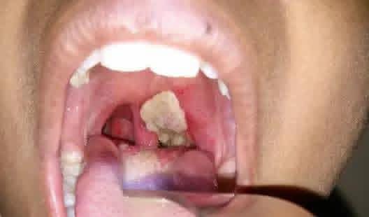 Kano Government Sets Up Committee to Investigate Diphtheria Cases and Deaths